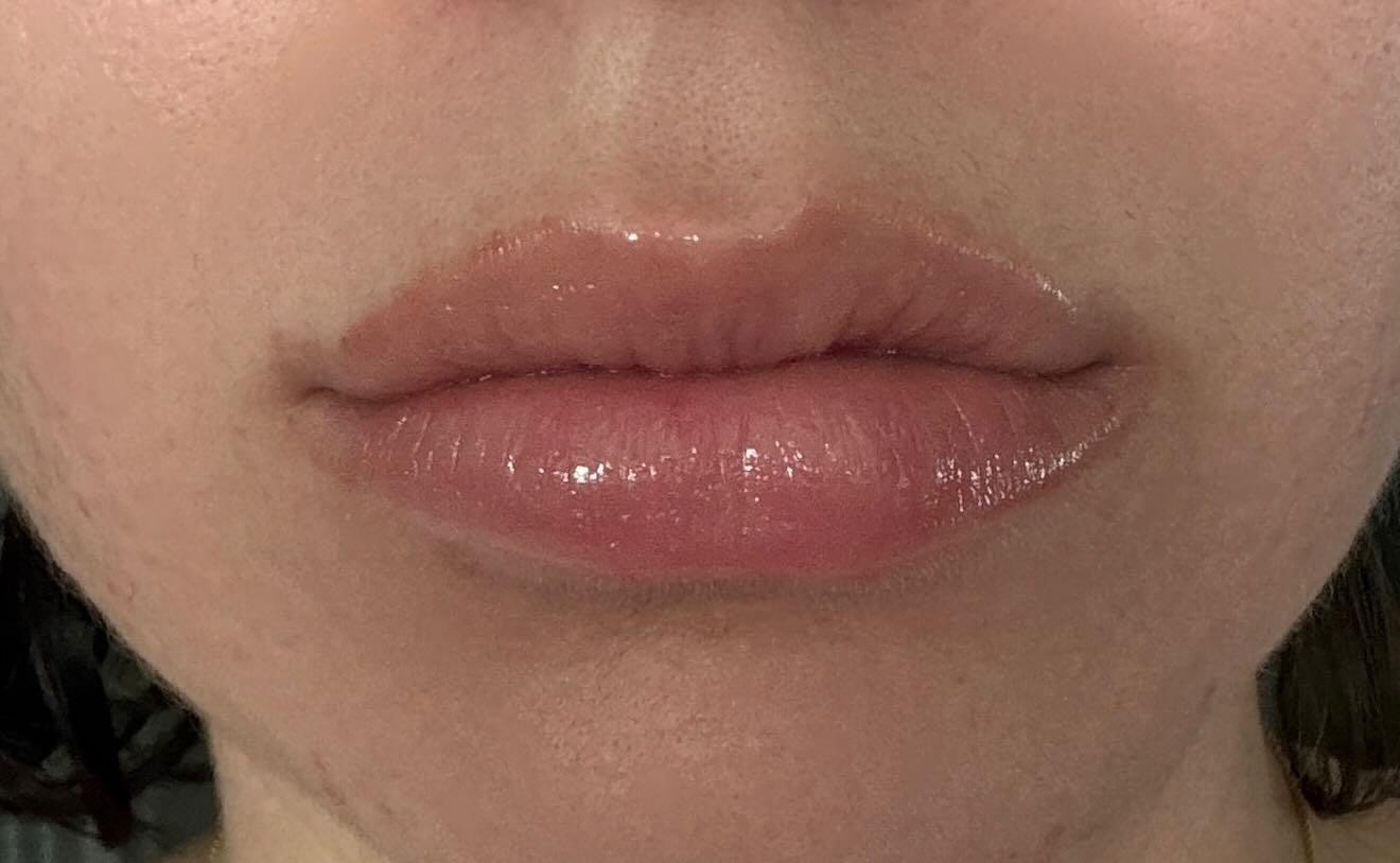 Lips after dermal filler treatment showing natural volume