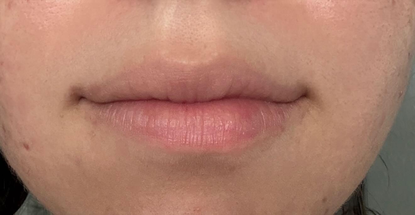 Lips before dermal filler treatment