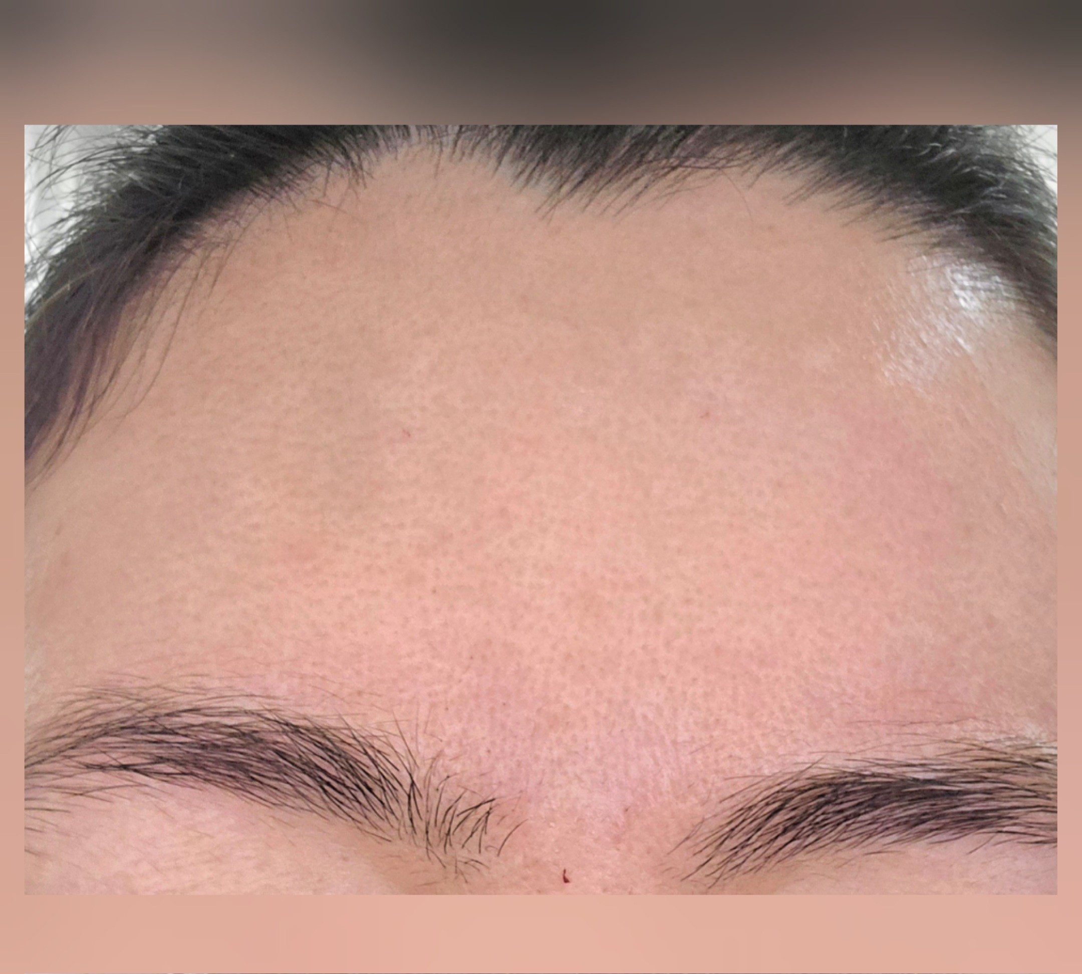 Forehead after neurotoxin treatment, showing smoothed skin