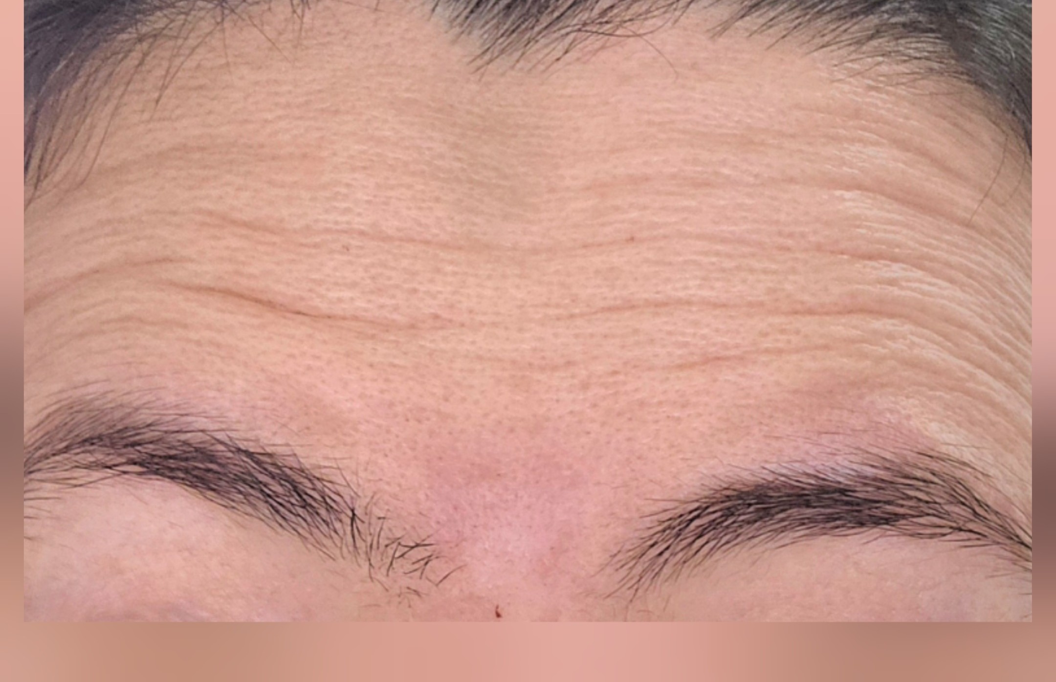 Forehead before neurotoxin treatment, showing visible forehead lines