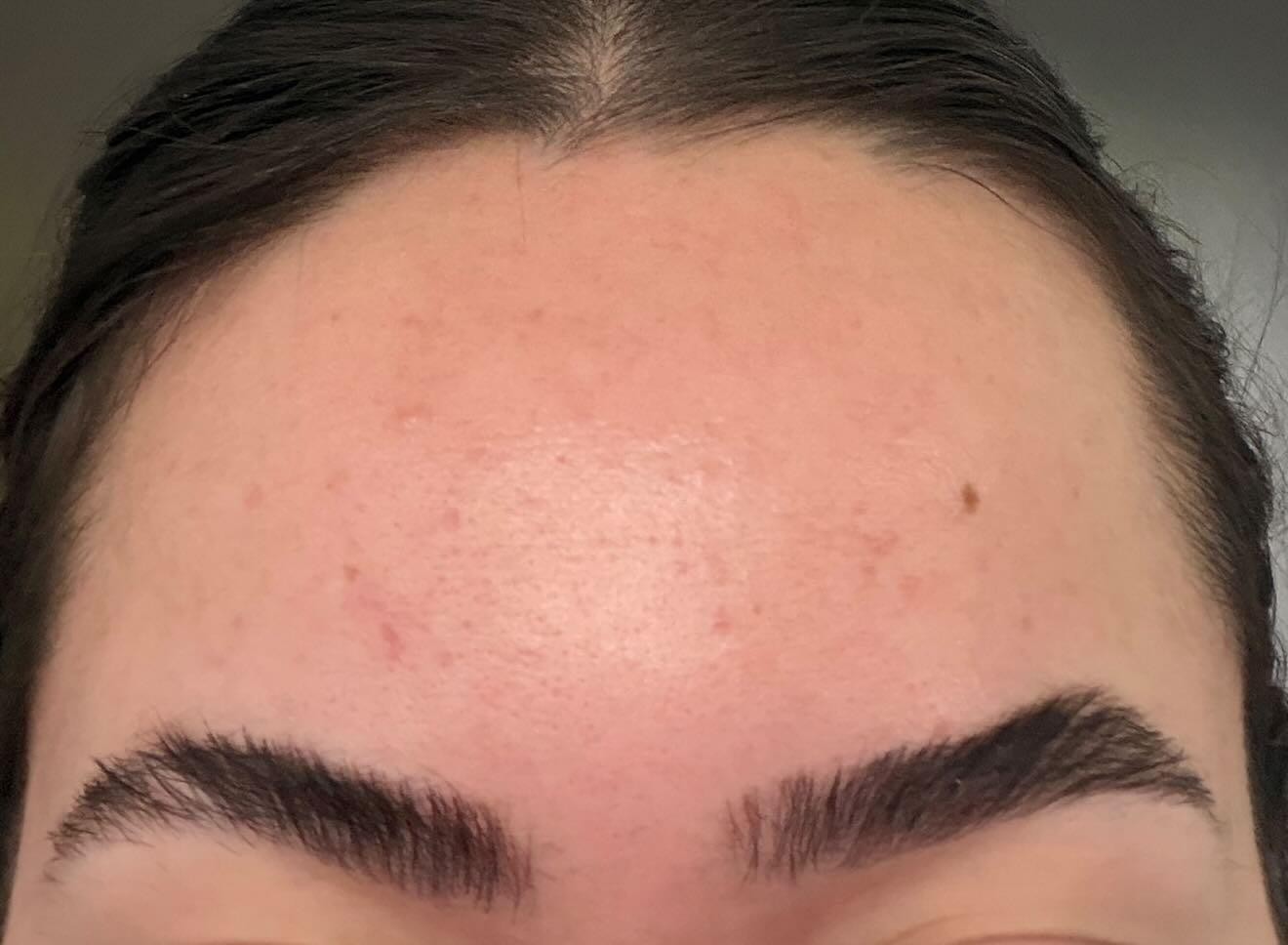 Forehead after neurotoxin treatment showing smooth skin