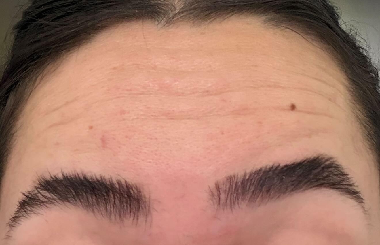 Forehead before neurotoxin treatment showing forehead lines