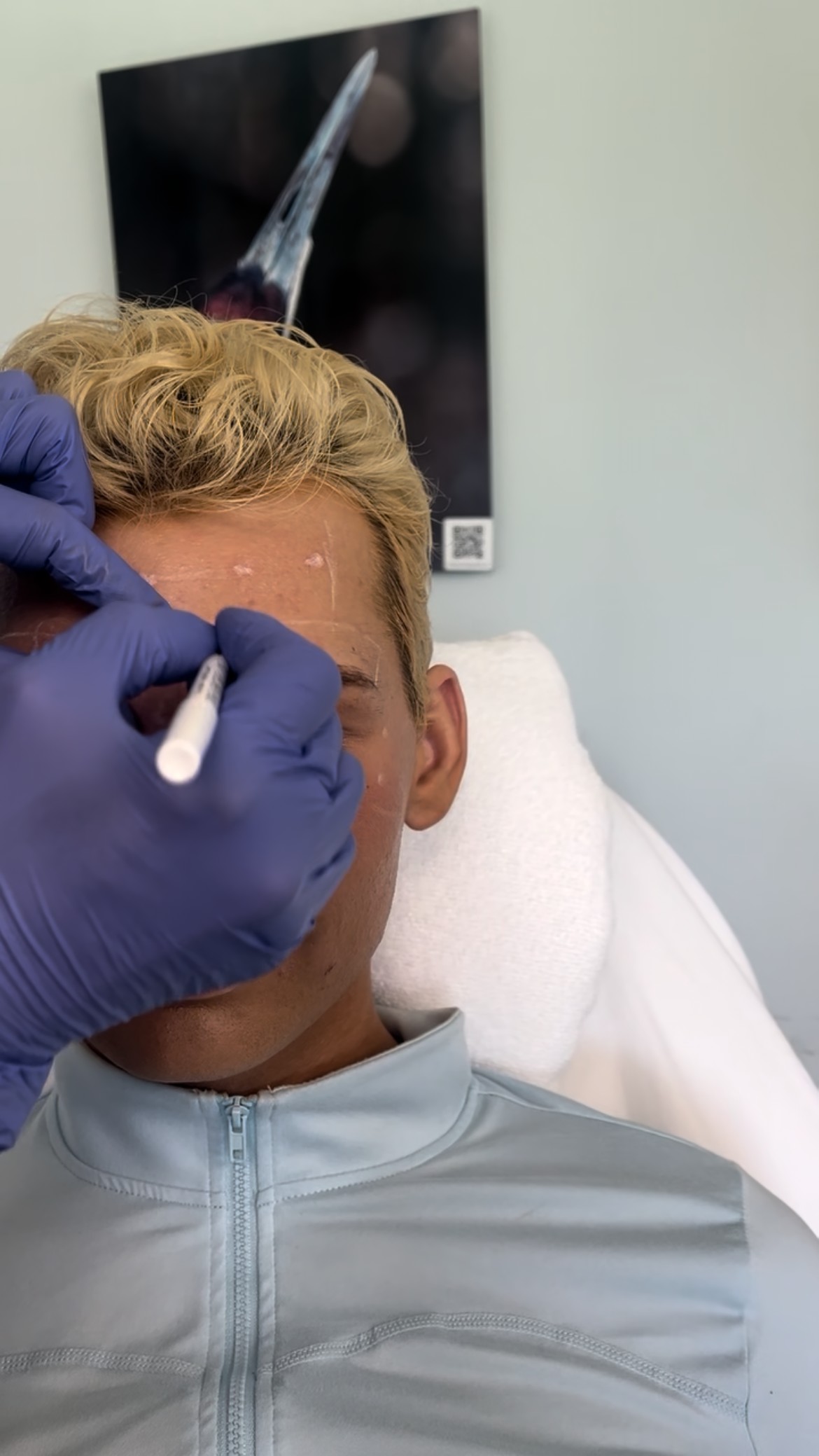 Neurotoxin treatment being administered at Altevé Aesthetics