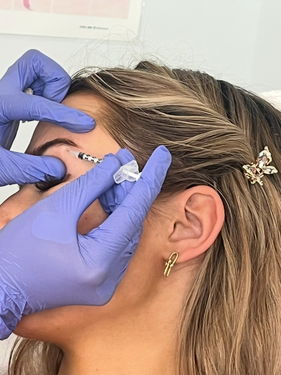 Precision neurotoxin injection at Altevé Aesthetics
